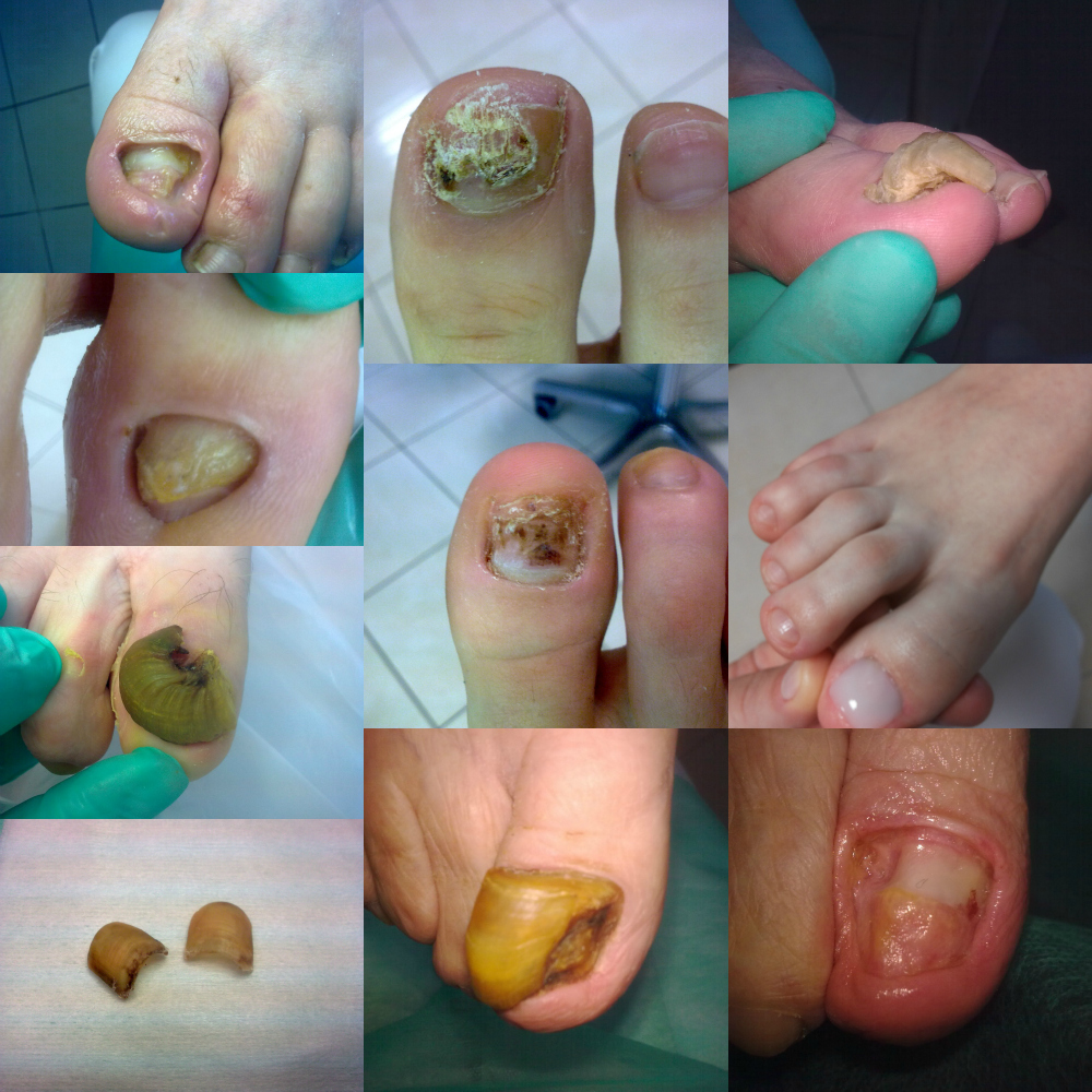 choroby paznokci